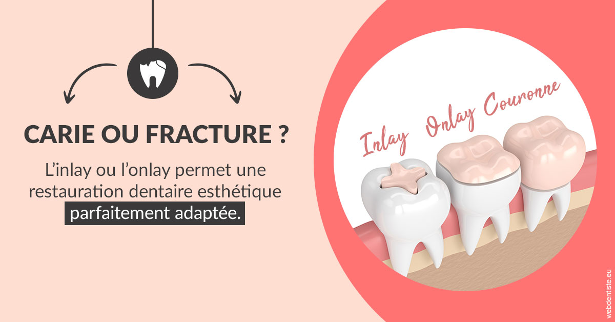 https://dr-picard-nicolas.chirurgiens-dentistes.fr/T2 2023 - Carie ou fracture 2
