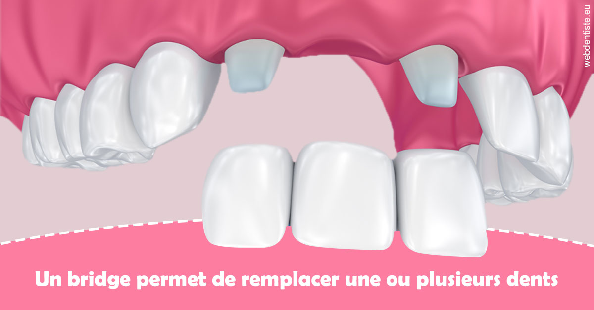 https://dr-picard-nicolas.chirurgiens-dentistes.fr/Bridge remplacer dents 2