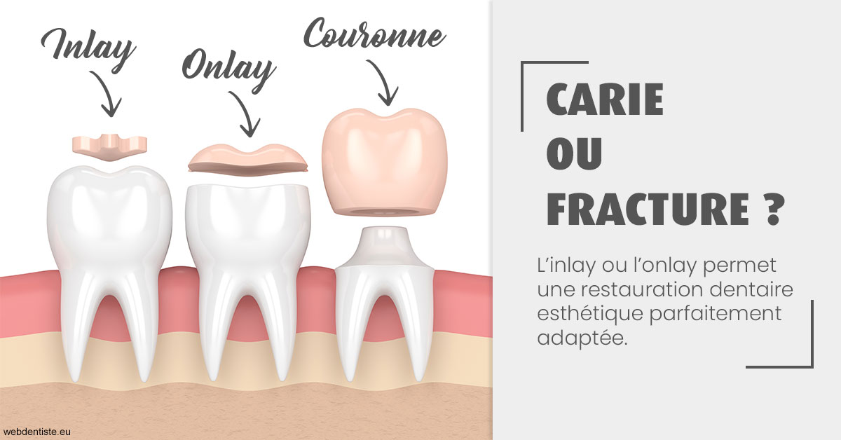 https://dr-picard-nicolas.chirurgiens-dentistes.fr/T2 2023 - Carie ou fracture 1