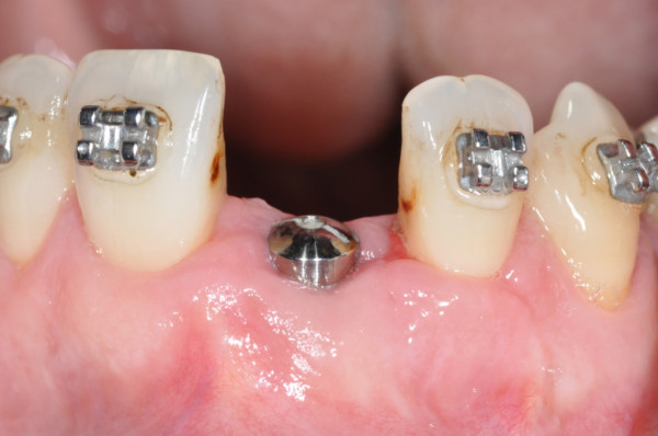 Cas cliniques : implants dentaires au Cabinet du Docteur Picard à Rouen 76