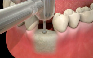 Pose d'implants dentaires au Cabinet du Docteur Picard à Rouen