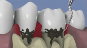 Le traitement non chirurgical de la parodontite : utilisation des ultras-sons